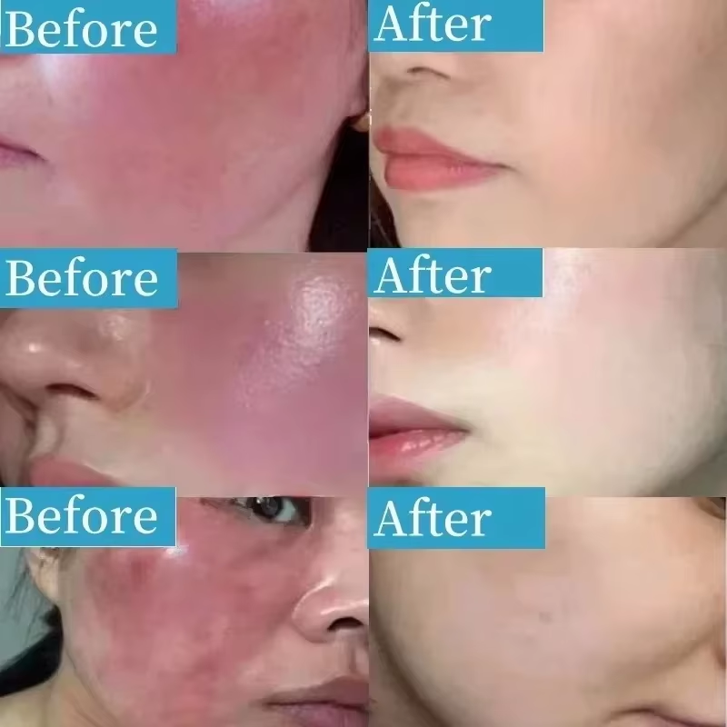 한국산 홍조 진정 크림, 민감성 피부를 위한 수분 진정 - Coenzyme Q10 Cream 리뷰 및 가격
