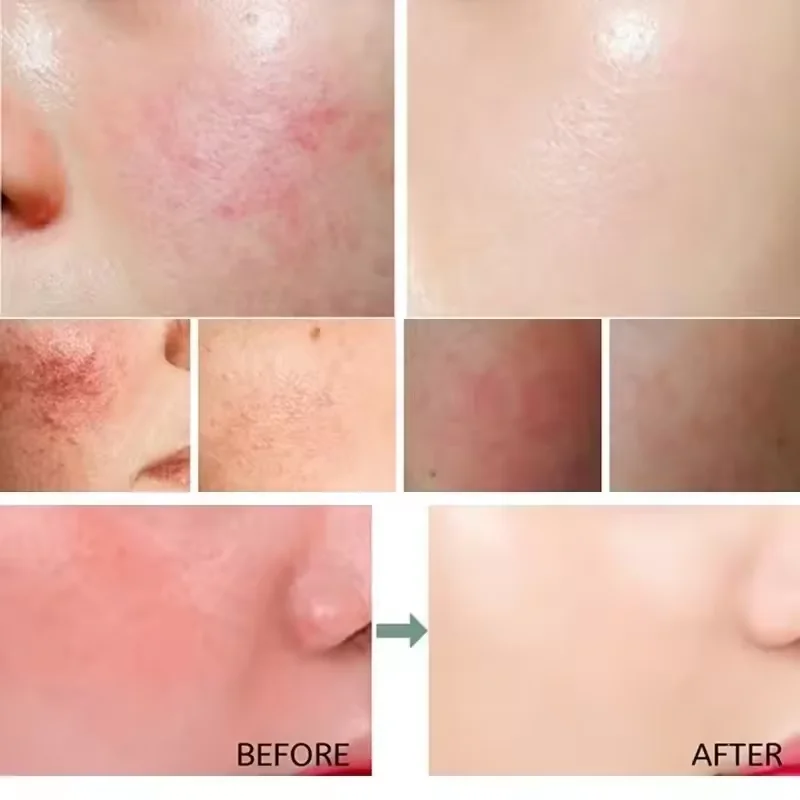 얼굴 붉음증 개선 크림 민감성 피부 건조 개선 보습 진 - Coenzyme Q10 Cream 리뷰 및 가격