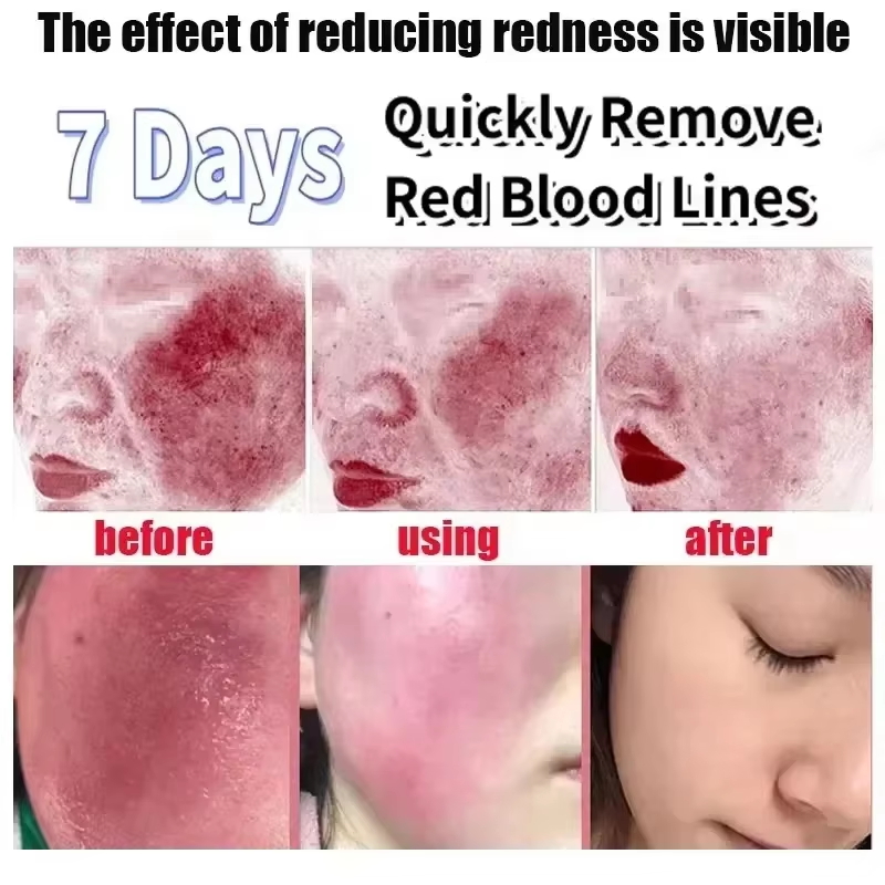 얼굴 홍조 개선 크림 민감성 피부 건조함 완화 수분 로 - Coenzyme Q10 Cream 리뷰 및 가격